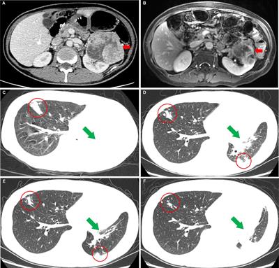 Clinical Benefit of Niraparib to TKI/mTORi-Resistance Metastatic ccRCC With BAP1-Frame Shift Mutation: Case Report and Literature Review